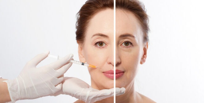 Dermal Fillers