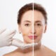 Dermal Fillers