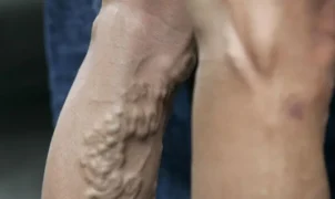 Varises