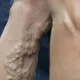 Varises