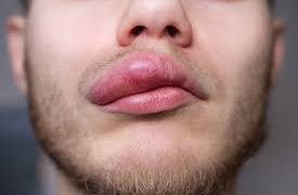 Bibir Bengkak